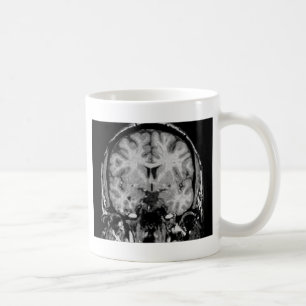 Hjärna MRI, coronalskiva Kaffemugg