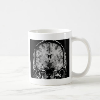 Hjärna MRI, coronalskiva Kaffemugg