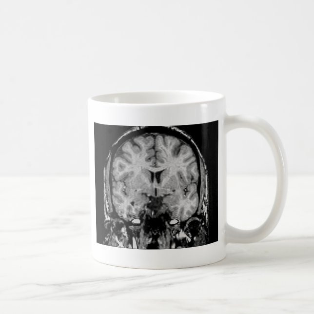 Hjärna MRI, coronalskiva Kaffemugg (Höger)