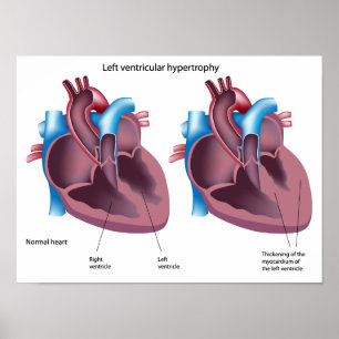 Hjärthypertrofi Poster