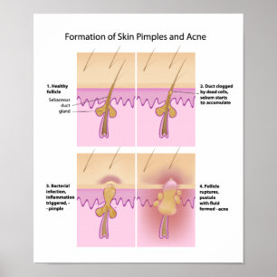 Hud Acne och par Poster