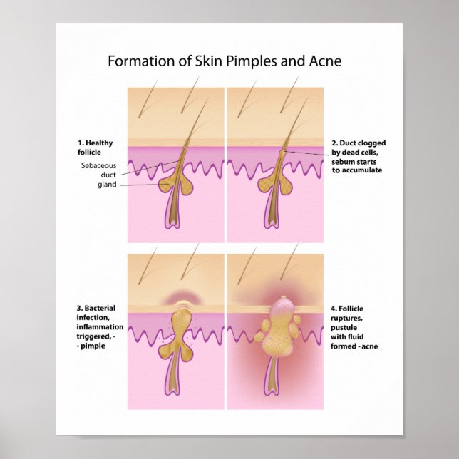 Hud Acne och par Poster (Framsidan)