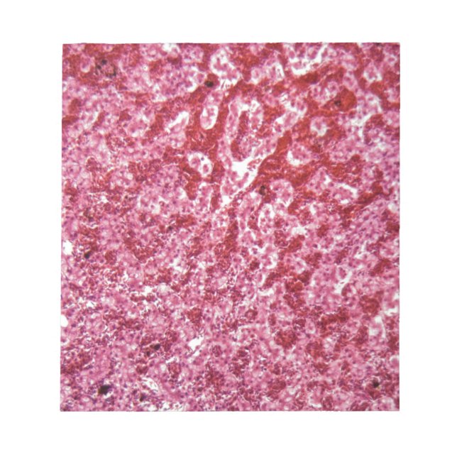 Humana leverceller med cancer anteckningsblock (Framsida)