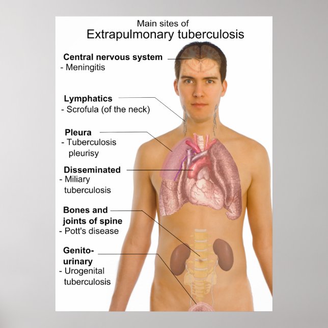Huvudsymptom på Extrapulmonellt tuberkulosdiagram Poster (Framsidan)