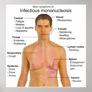 Huvudsymptom på infektiösa mononukleosdiagram poster