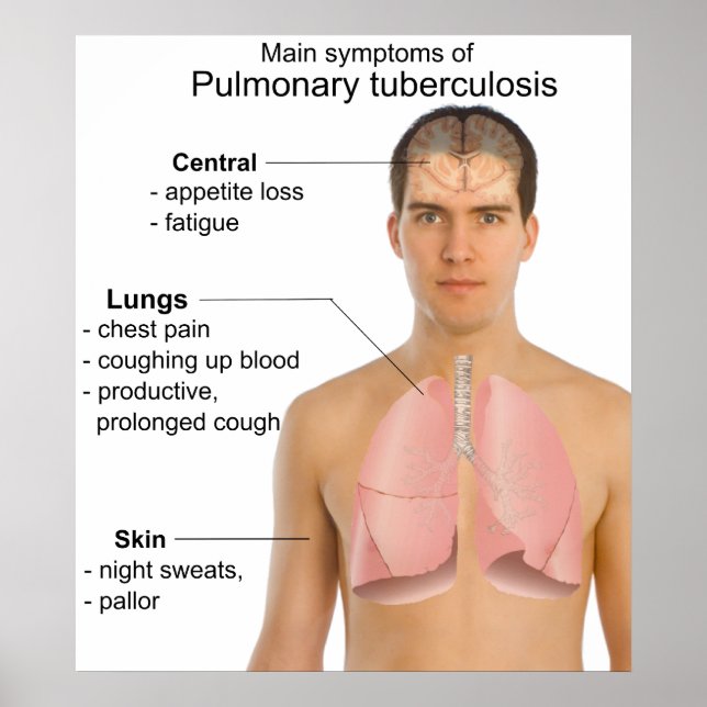 Huvudsymptom på pulmonellt tuberkulosdiagram poster (Framsidan)