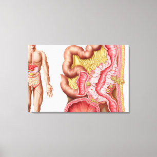 Illustration av Diverticulosis i kolonet Canvastryck