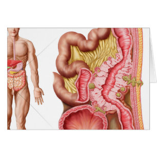 Illustration av Diverticulosis i kolonet Hälsningskort