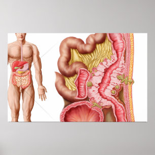 Illustration av Diverticulosis i kolonet Poster