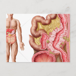 Illustration av divertikulosis i kolon vykort