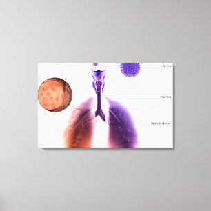 Illustration av en astmaattack från pollen canvastryck