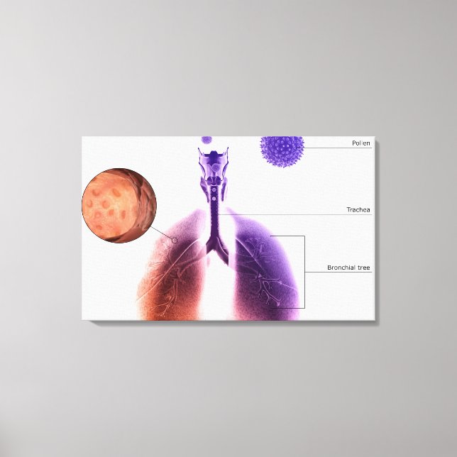 Illustration av en astmaattack från pollen canvastryck (Framsida)