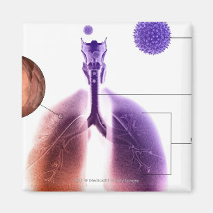 Illustration av en astmaattack från pollen magnet
