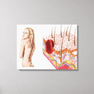 Illustration av en Atypical tillväxt på flå Canvastryck