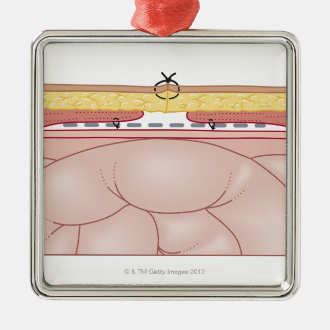 Illustration av en bråck julgransprydnad metall (Framsidan)