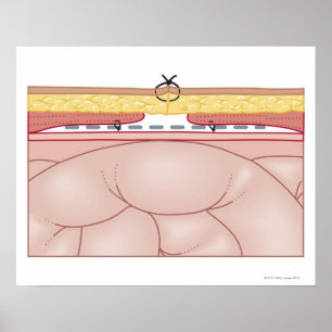 Illustration av en bråck poster
