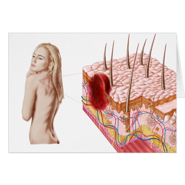 Illustration av onormal tillväxt på huden hälsningskort (Framsidan Horizontal)