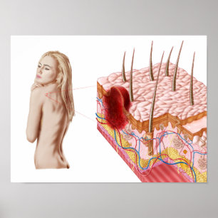 Illustration av onormal tillväxt på huden poster