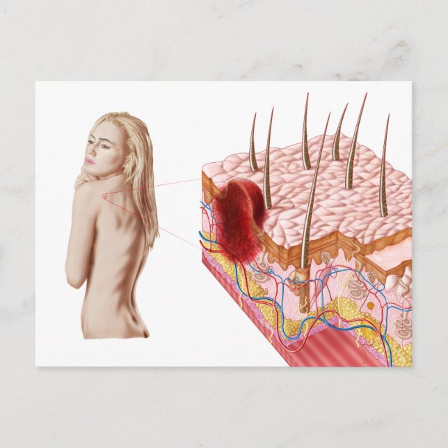 Illustration av onormal tillväxt på huden vykort (Framsida)