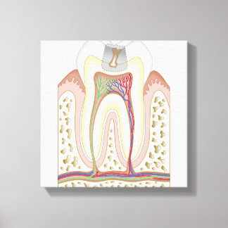 Illustration av tandförfall canvastryck