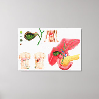 Illustration avbildning av kemoecystektomi canvastryck