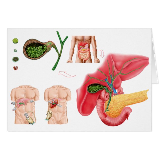 Illustration avbildning av kemoecystektomi hälsningskort (Framsidan Horizontal)