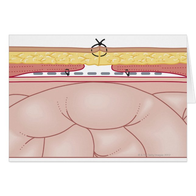 Illustration of a Hernia Hälsningskort (Framsidan Horizontal)