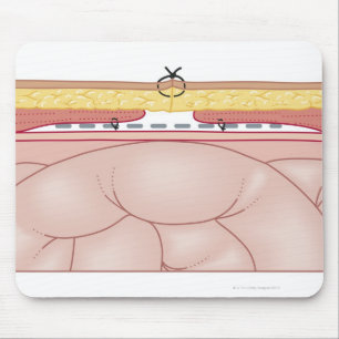 Illustration of a Hernia Musmatta