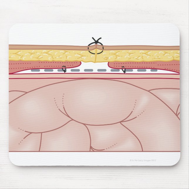 Illustration of a Hernia Musmatta (Framsidan)