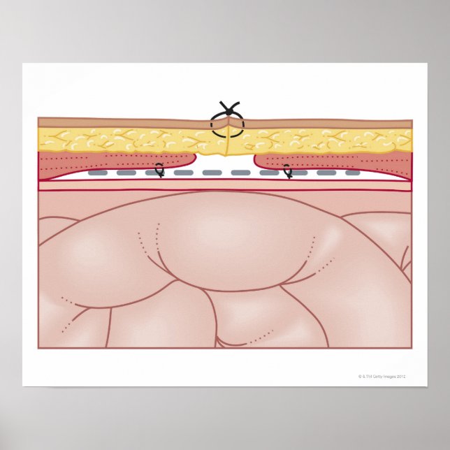 Illustration of a Hernia Poster (Framsidan)