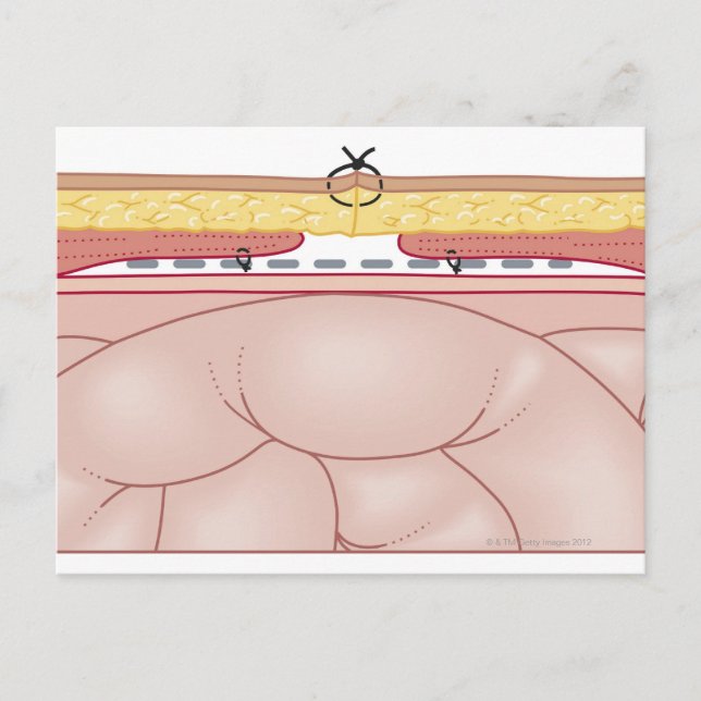 Illustration of a Hernia Vykort (Framsida)