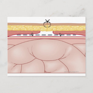 Illustration of a Hernia Vykort