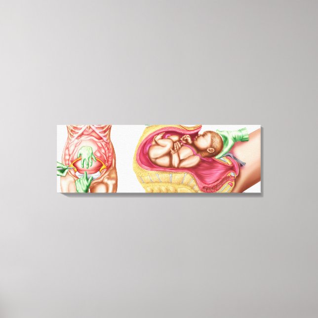 Illustration som visar att kejsarsnitt levererar b canvastryck (Framsida)