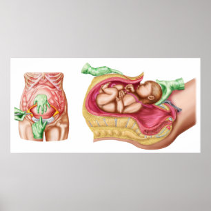 Illustration som visar att kejsarsnitt levererar b poster