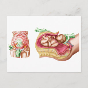 Illustration som visar att kejsarsnitt levererar b vykort
