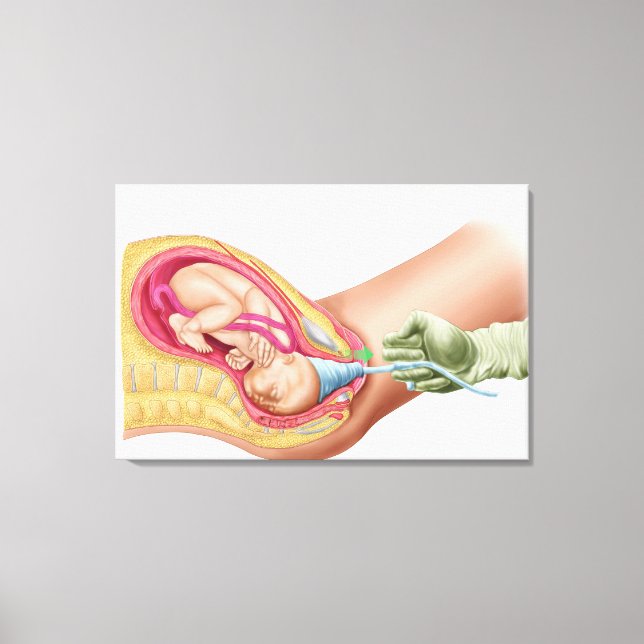 Illustration som visar leverans av Fetus 1 Canvastryck (Framsida)