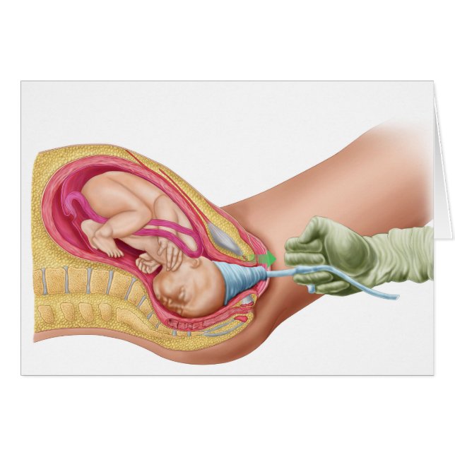 Illustration som visar leverans av Fetus 1 Hälsningskort (Framsidan Horizontal)