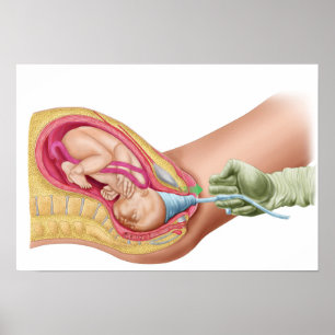 Illustration som visar leverans av Fetus 1 Poster