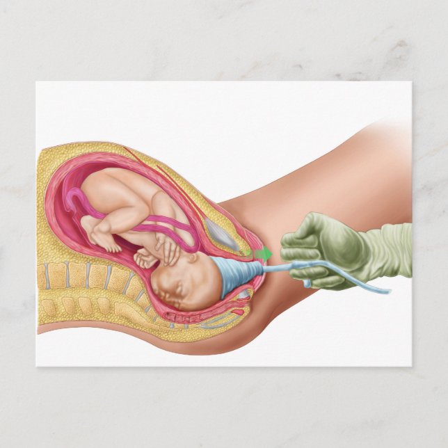 Illustration som visar leverans av Fetus 1 Vykort (Framsida)