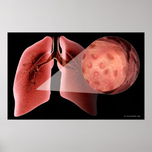 Inflammed flygbolag under en astmaattack poster