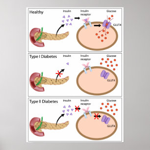 Insulinaktivitet och diabetes typ 1 och 2 Poster