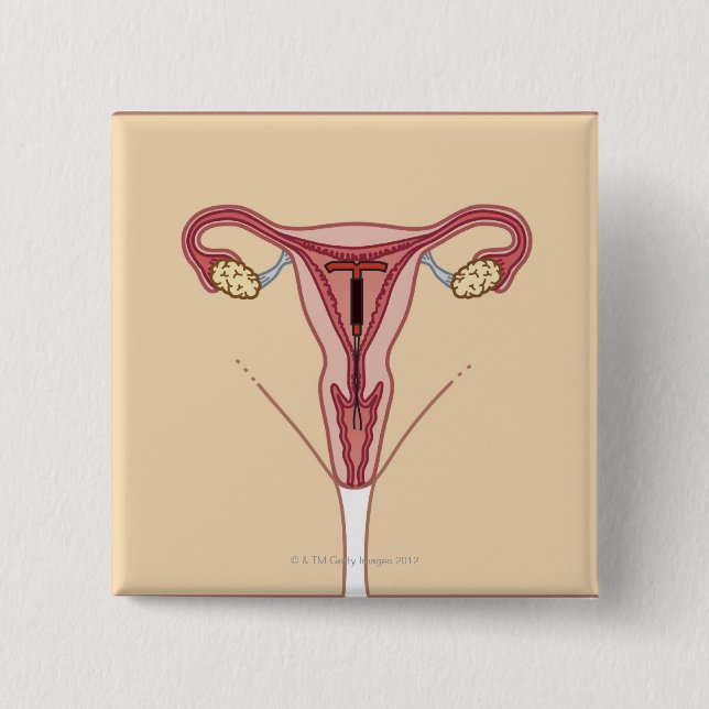 Intrauterine Device Knapp (Framsida)