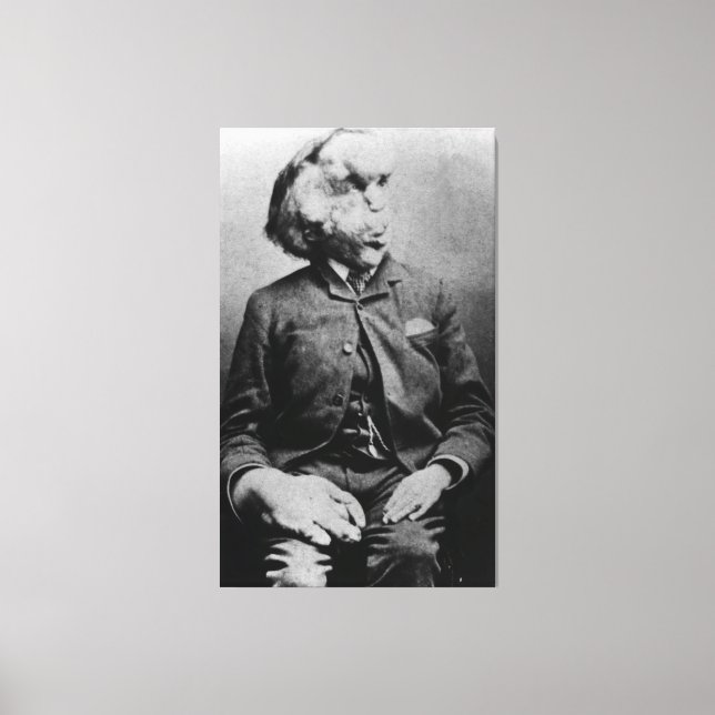 Joseph "John" Merrick The Elephant Man från 1889 Canvastryck (Framsida)