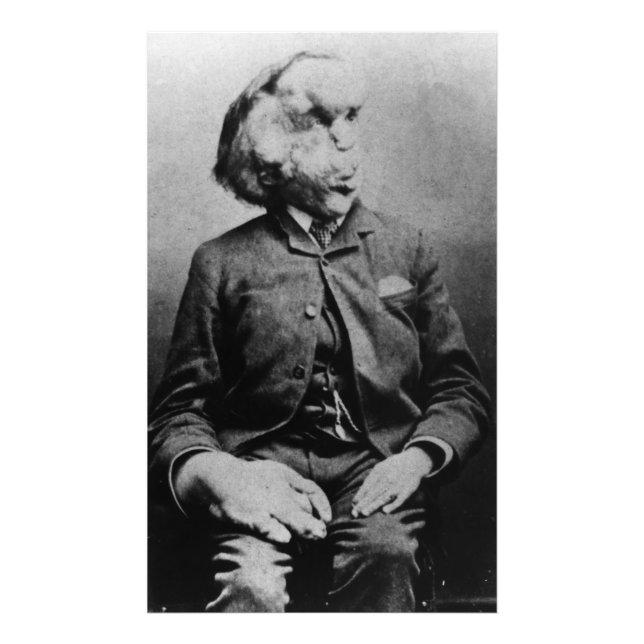 Joseph "John" Merrick The Elephant Man från 1889 Fototryck (Framsidan)