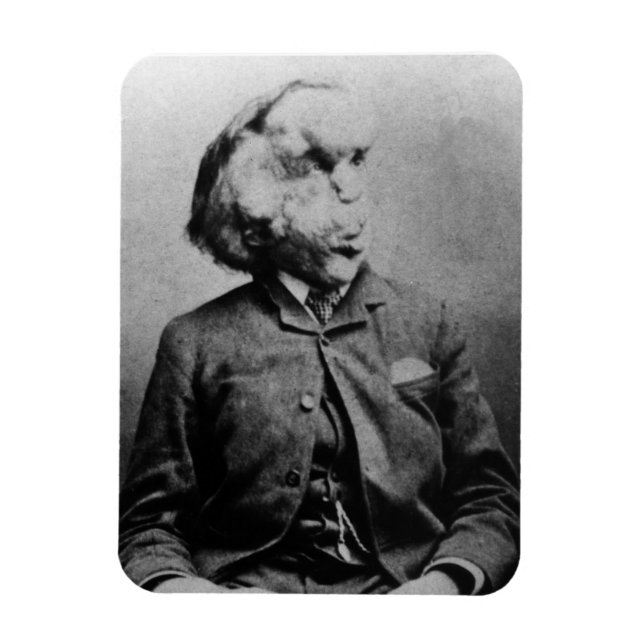 Joseph "John" Merrick The Elephant Man från 1889 Magnet (Vertikal)