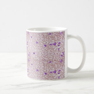 Kaffemugg - kronisk Myeloid Leukemia (CML)