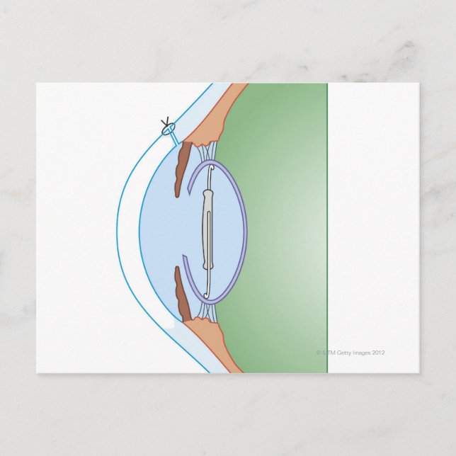 Kataraktkirurgi Vykort (Framsida)