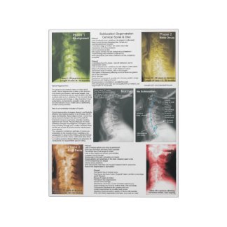 Kervik degenerering av tjärp-sladdning anteckningsblock