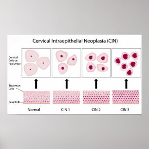 Kerviskt dysplasi-stadium och pap-utstryksprov poster