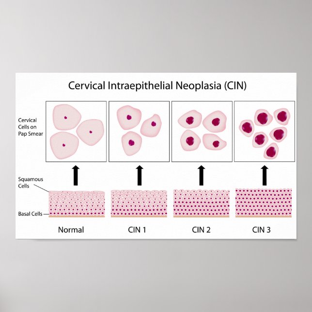 Kerviskt dysplasi-stadium och pap-utstryksprov poster (Framsidan)